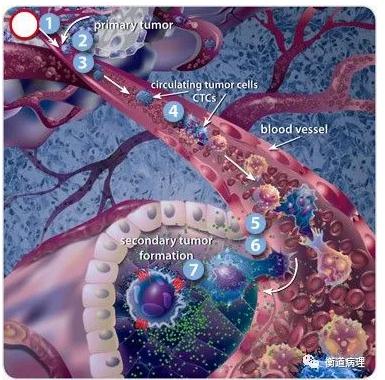 癌癥轉(zhuǎn)移機(jī)制