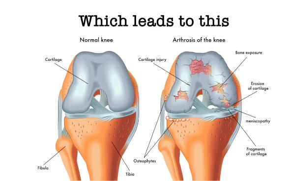 微流控“軟骨”芯片（Knee On Chip）用于關節(jié)炎研究