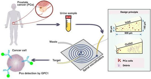 有望無(wú)創(chuàng)檢測(cè)前列腺癌的微流控芯片